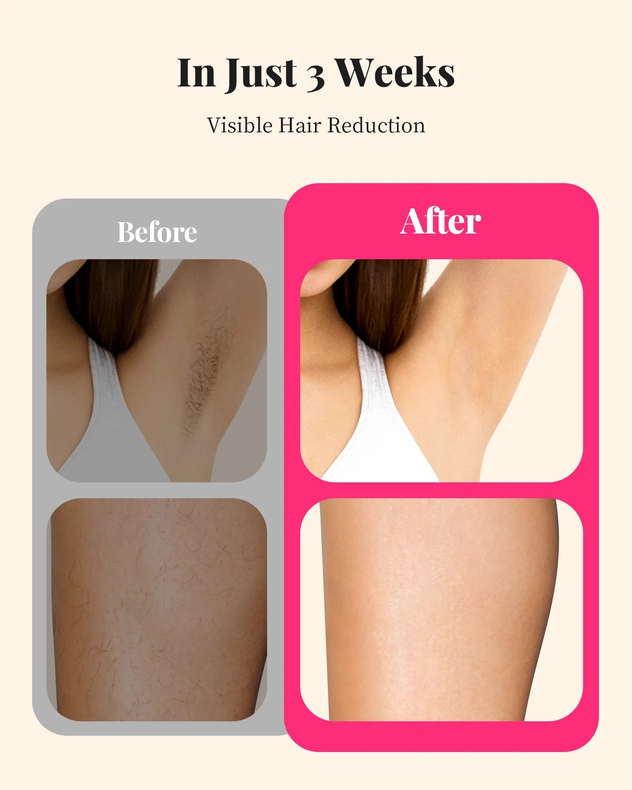 990000 Flashes Laser Hair Removal, UNISEX, Hair Removal, Body, Bikini, and Facial Areas, Painless, Permanent Hair Removal